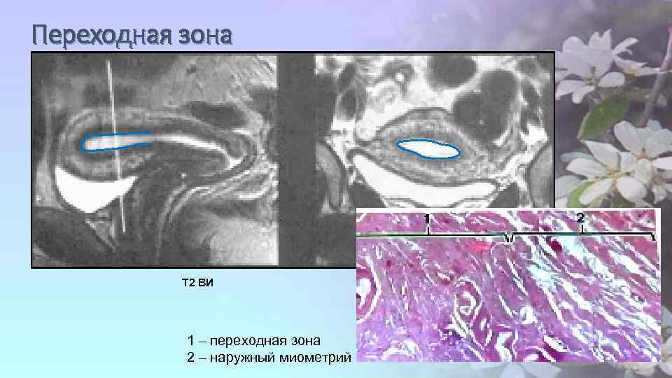 Переходная зона Т 2 ВИ 1 – переходная зона 2 – наружный миометрий 