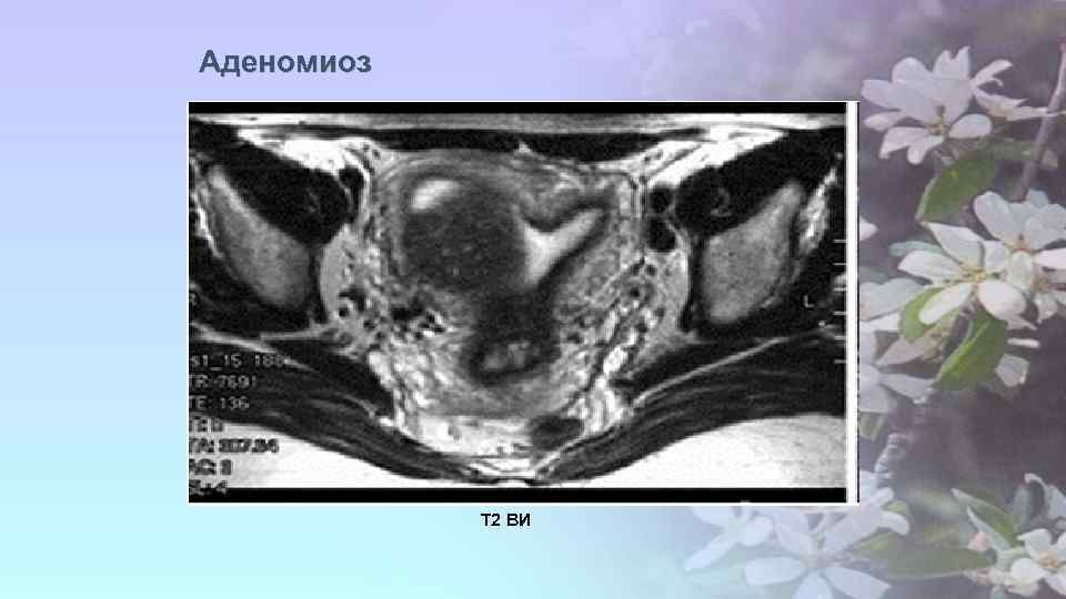 Аденомиоз Т 2 ВИ 