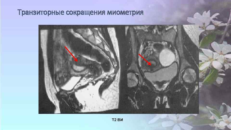 Транзиторные сокращения миометрия Т 2 ВИ 