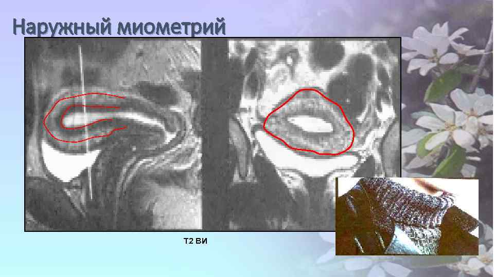 Наружный миометрий Т 2 ВИ 