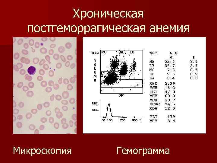 Картина крови при острой постгеморрагической анемии