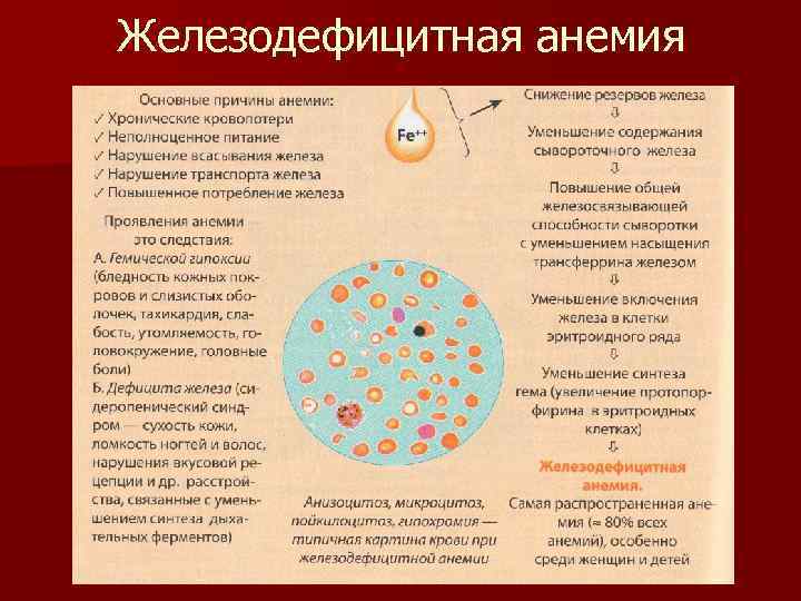 Железодефицитная анемия 