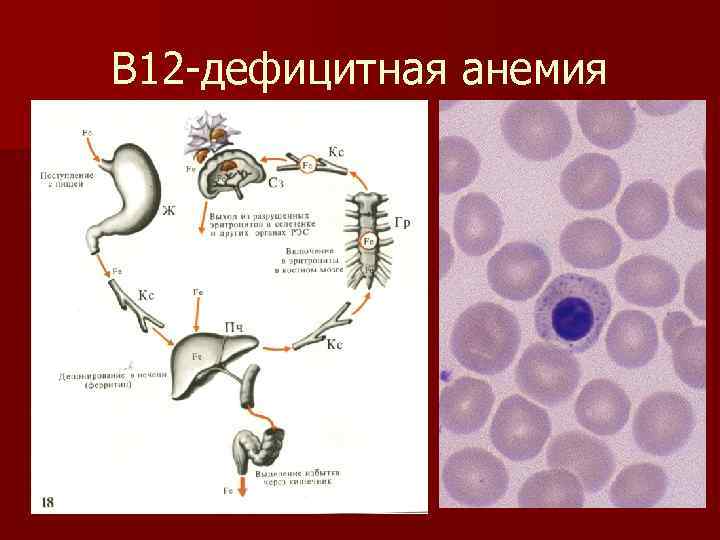 В 12 -дефицитная анемия 