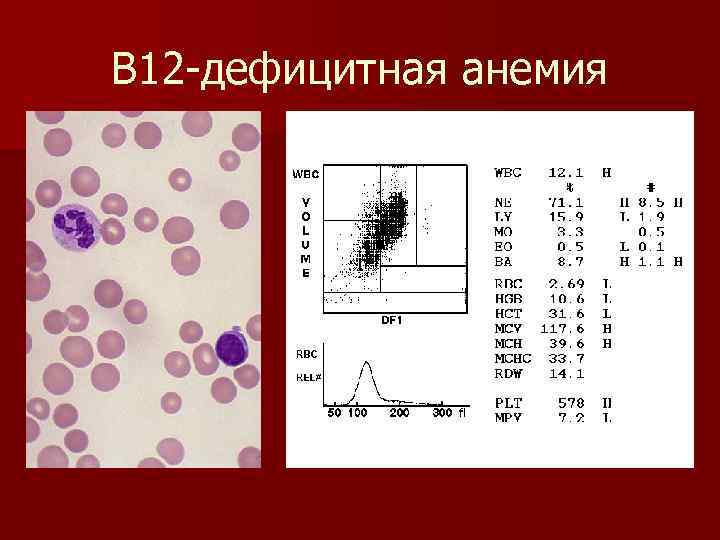 В 12 -дефицитная анемия 