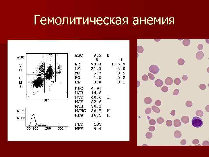 Гемолитическая анемия 