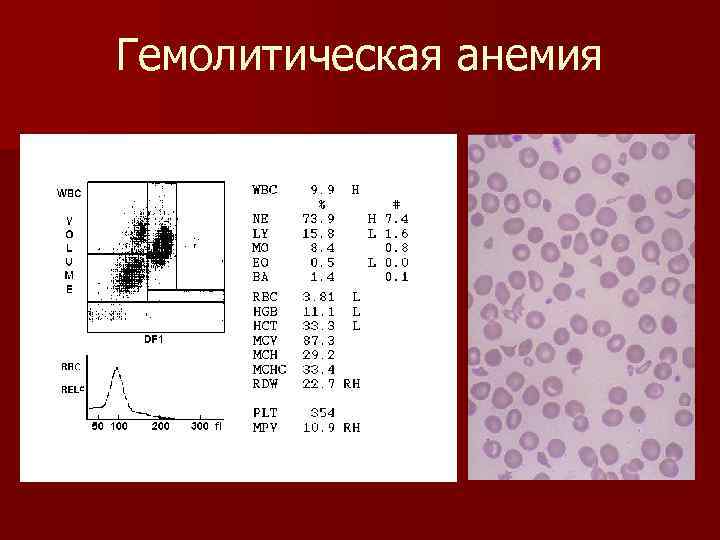 Гемолитическая анемия 