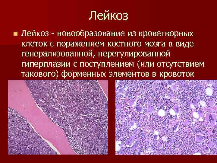 Лейкоз n Лейкоз - новообразование из кроветворных клеток с поражением костного мозга в виде