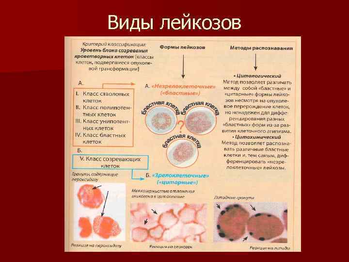 Виды лейкозов 