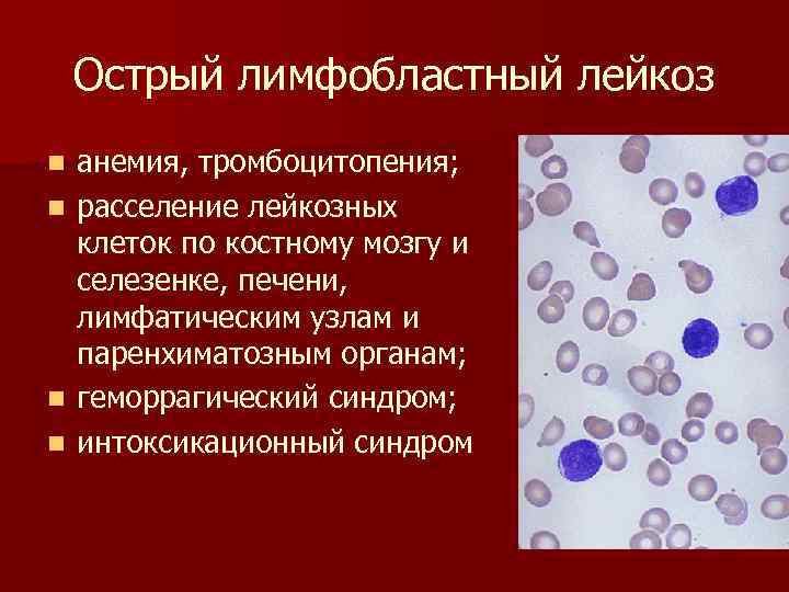 Острый лимфобластный лейкоз анемия, тромбоцитопения; n расселение лейкозных клеток по костному мозгу и селезенке,