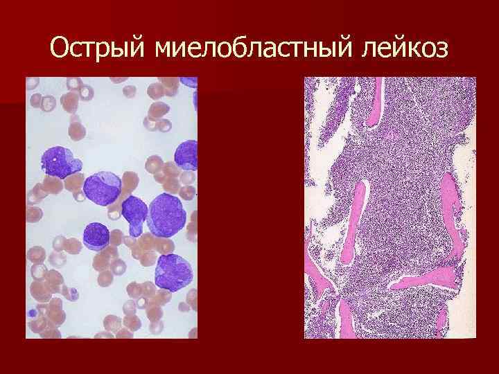 Острый миелобластный лейкоз 