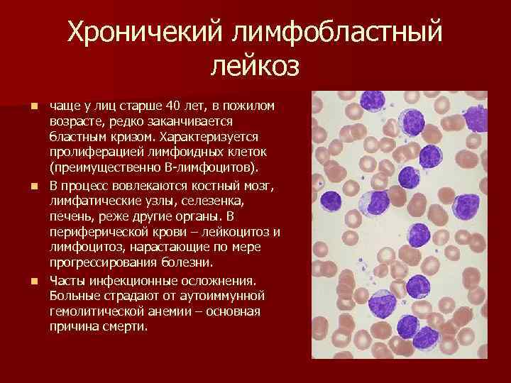 Хроничекий лимфобластный лейкоз чаще у лиц старше 40 лет, в пожилом возрасте, редко заканчивается