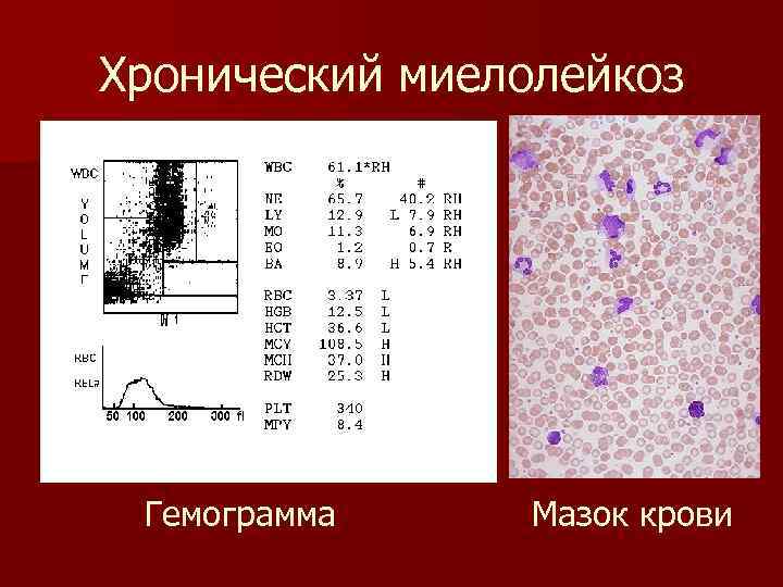 Хронический миелолейкоз Гемограмма Мазок крови 