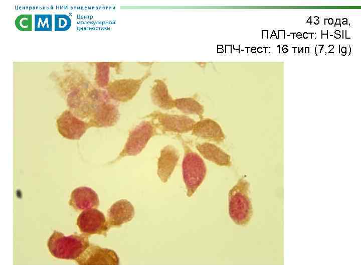 43 года, ПАП-тест: H-SIL ВПЧ-тест: 16 тип (7, 2 lg) 