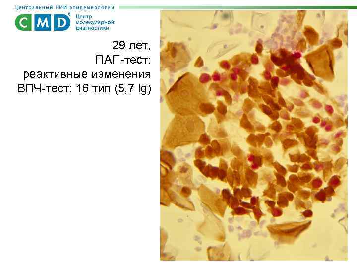 29 лет, ПАП-тест: реактивные изменения ВПЧ-тест: 16 тип (5, 7 lg) 