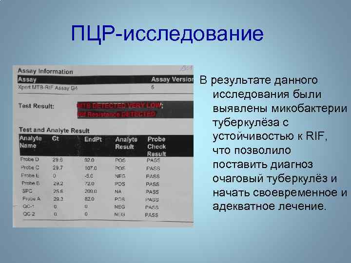 ПЦР-исследование В результате данного исследования были выявлены микобактерии туберкулёза с устойчивостью к RIF, что