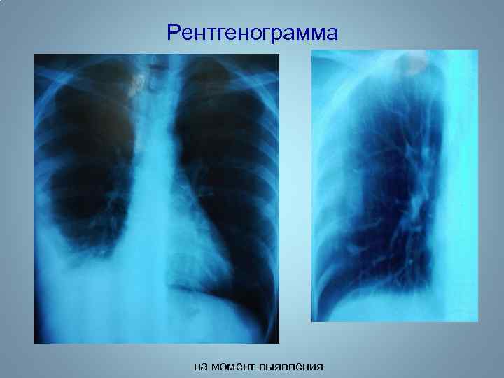 Рентгенограмма на момент выявления 