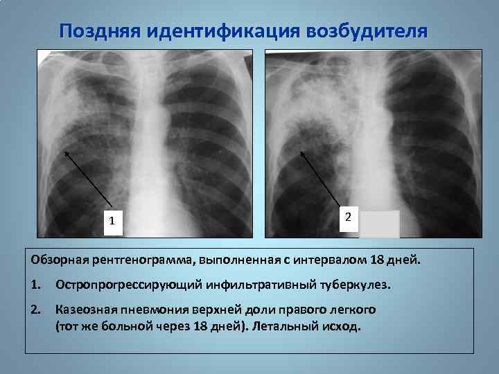 Поздняя идентификация возбудителя 1 2 Обзорная рентгенограмма, выполненная с интервалом 18 дней. 1. Остропрогрессирующий