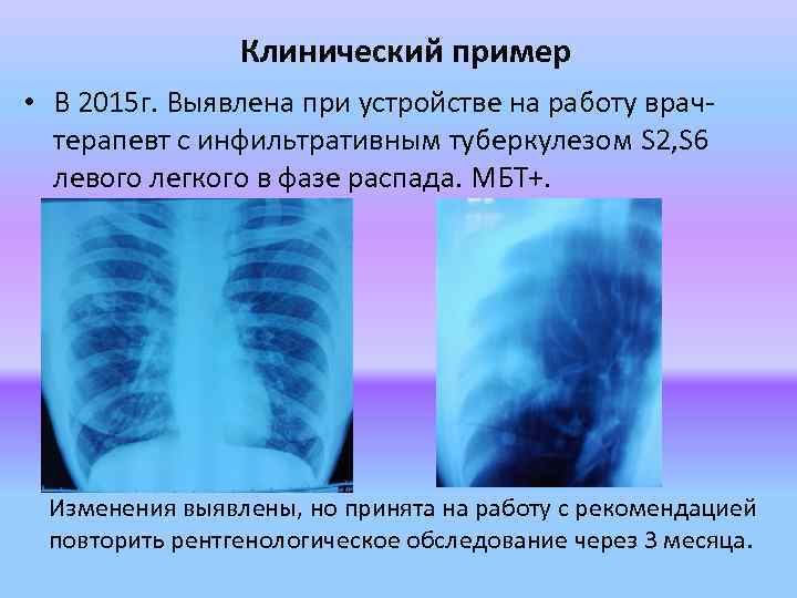 Клинический пример • В 2015 г. Выявлена при устройстве на работу врачтерапевт с инфильтративным