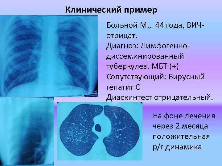 Клинический пример Больной М. , 44 года, ВИЧотрицат. Диагноз: Лимфогеннодиссеминированный туберкулез. МБТ (+) Сопутствующий: