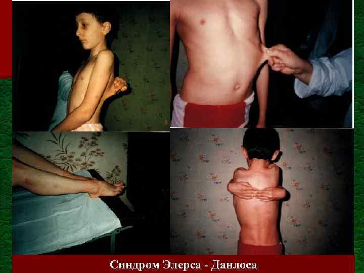 Синдром Элерса - Данлоса 
