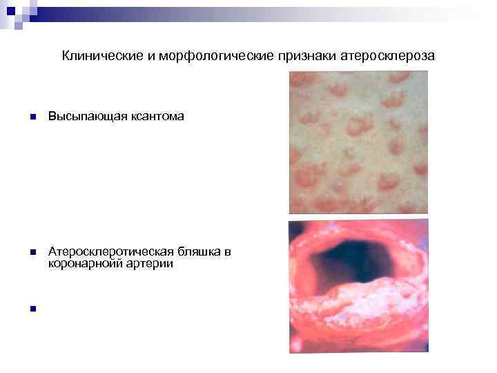 Клинические и морфологические признаки атеросклероза Высыпающая ксантома Атеросклеротическая бляшка в коронарнойй артерии 