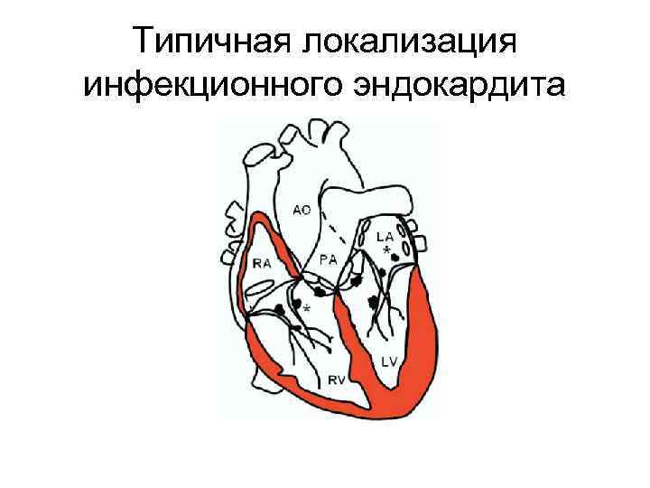 Типичная локализация инфекционного эндокардита 