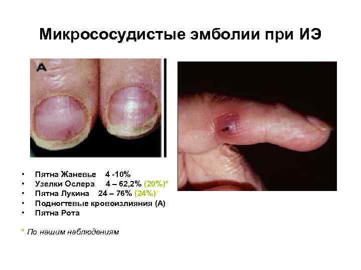 Микрососудистые эмболии при ИЭ • • • Пятна Жаневье 4 -10% Узелки Ослера 4