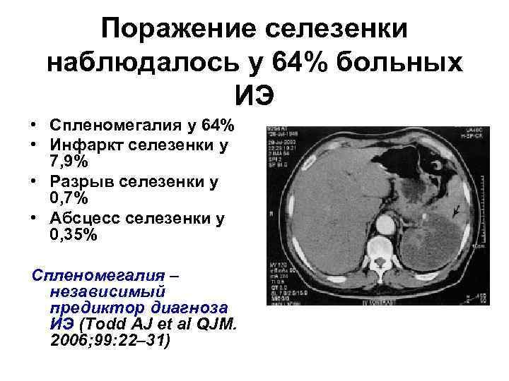 Поражение селезенки наблюдалось у 64% больных ИЭ • Спленомегалия у 64% • Инфаркт селезенки