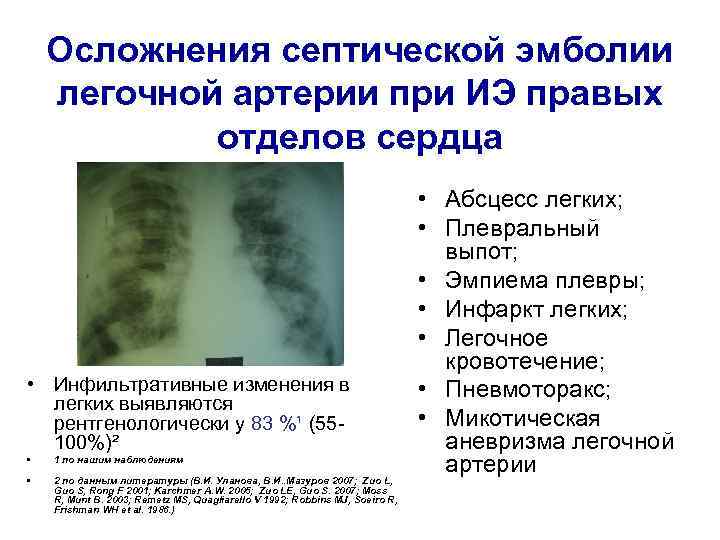 Осложнения септической эмболии легочной артерии при ИЭ правых отделов сердца • Инфильтративные изменения в