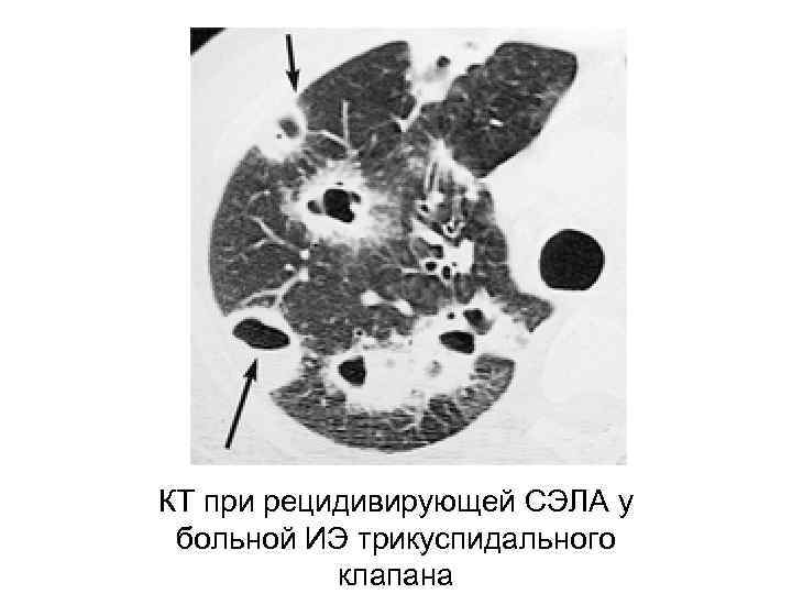 КТ при рецидивирующей СЭЛА у больной ИЭ трикуспидального клапана 