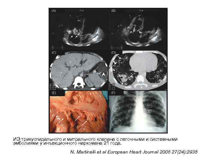 ИЭ трикуспидального и митрального клапана с легочными и системными эмболиями у инъекционного наркомана 21