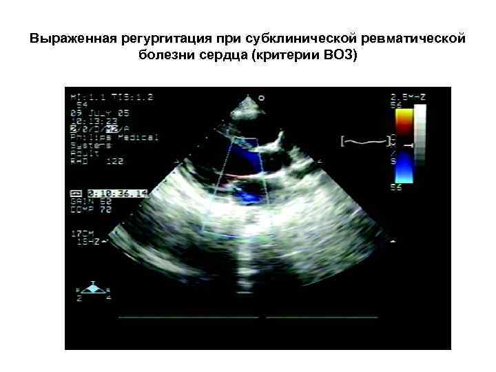 Выраженная регургитация при субклинической ревматической болезни сердца (критерии ВОЗ) 