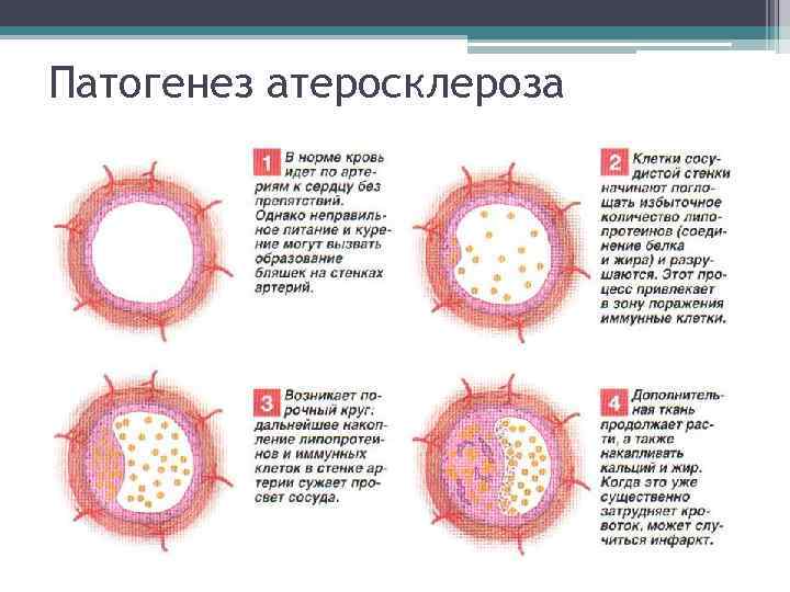 Патогенез атеросклероза 