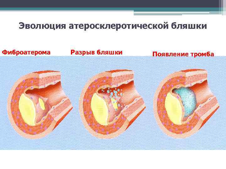 Эволюция атеросклеротической бляшки Фиброатерома Разрыв бляшки Появление тромба 