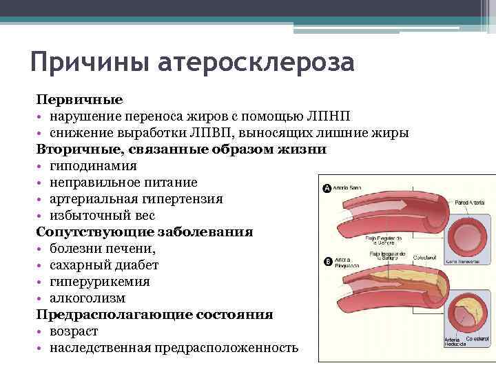 Причины атеросклероза Первичные • нарушение переноса жиров с помощью ЛПНП • снижение выработки ЛПВП,