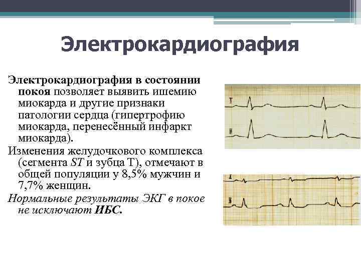 Электрокардиография в состоянии покоя позволяет выявить ишемию миокарда и другие признаки патологии сердца (гипертрофию