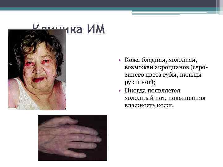 Клиника ИМ • Кожа бледная, холодная, возможен акроцианоз (серосинего цвета губы, пальцы рук и