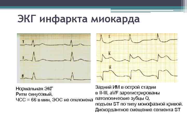ЭКГ инфаркта миокарда Задний ИМ в острой стадии Нормальная ЭКГ в II-III, a. VF