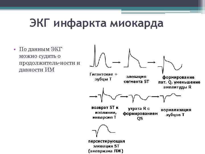 ЭКГ инфаркта миокарда • По данным ЭКГ можно судить о продолжитель-ности и давности ИМ