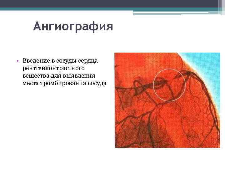 Ангиография • Введение в сосуды сердца рентгенконтрастного вещества для выявления места тромбирования сосуда 