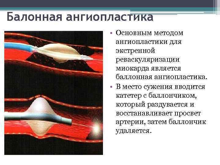 Балонная ангиопластика • Основным методом ангиопластики для экстренной реваскуляризации миокарда является баллонная ангиопластика. •