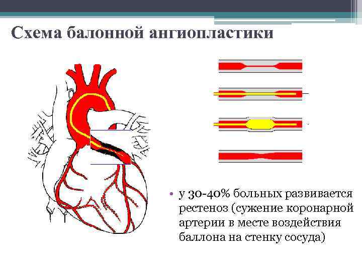 Схема балонной ангиопластики • у 30 -40% больных развивается рестеноз (сужение коронарной артерии в