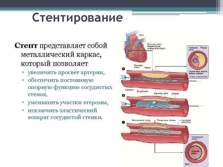 Стентирование Стент представляет собой металлический каркас, который позволяет ▫ увеличить просвет артерии, ▫ обеспечить