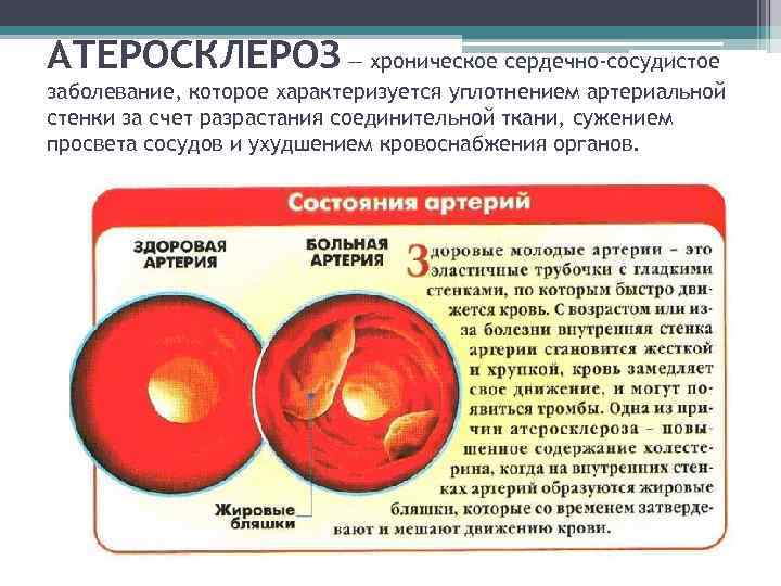 АТЕРОСКЛЕРОЗ — хроническое сердечно-сосудистое заболевание, которое характеризуется уплотнением артериальной стенки за счет разрастания соединительной