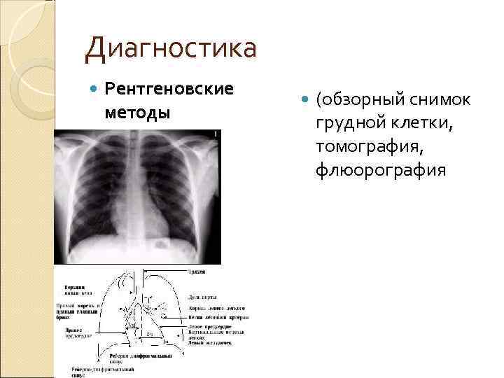 Диагностика Рентгеновские методы (обзорный снимок грудной клетки, томография, флюорография 