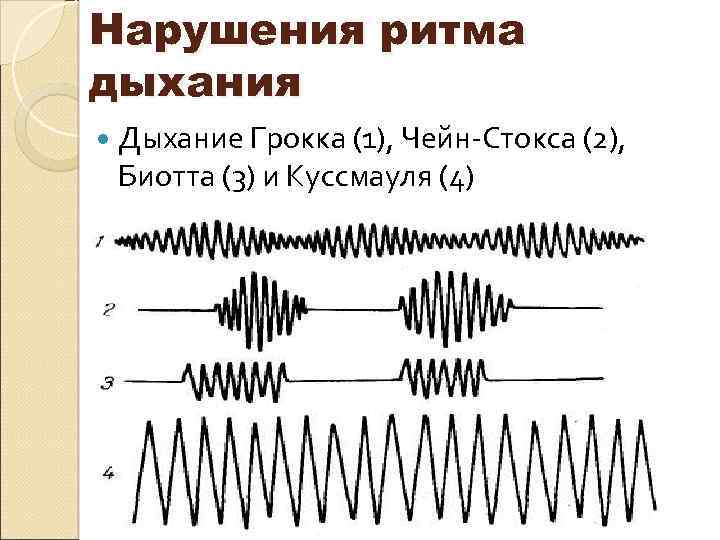 Нарушения ритма дыхания Дыхание Грокка (1), Чейн-Стокса (2), Биотта (3) и Куссмауля (4) 