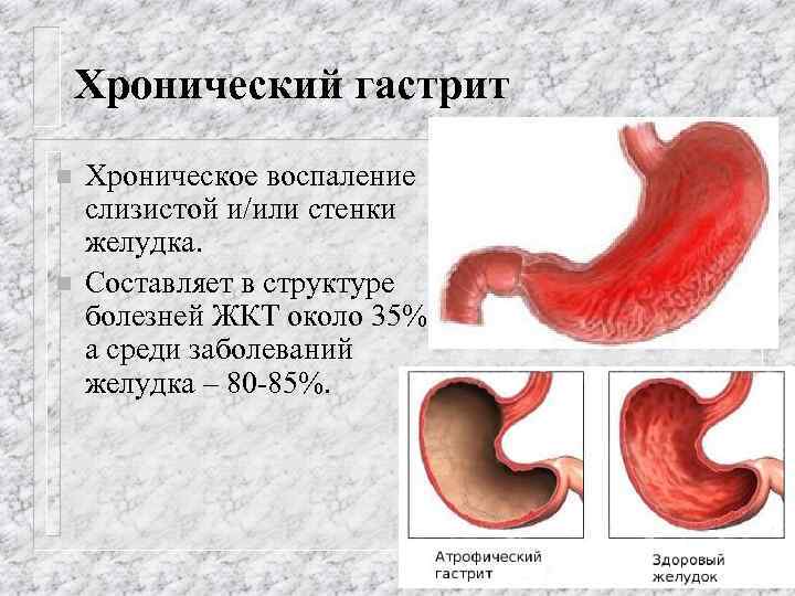 Хронический гастрит n n Хроническое воспаление слизистой и/или стенки желудка. Составляет в структуре болезней