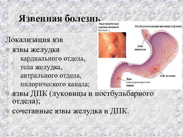 Язвенная болезнь Локализация язв n язвы желудка – – кардиального отдела, тела желудка, антрального