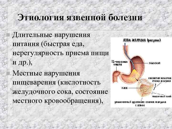 Этиология язвенной болезни Длительные нарушения питания (быстрая еда, нерегулярность приема пищи и др. ),