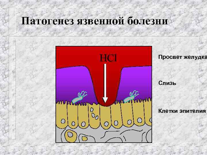 Патогенез язвенной болезни HCl Просвет желудка Слизь Клетки эпителия 